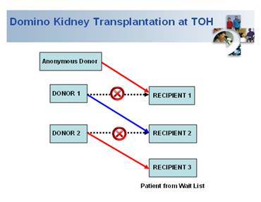 domino-kidney-transplantation