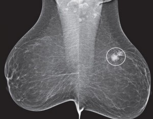 Breast Cancer Mammogram Image
