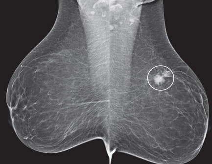 Breast Cancer mammo image WEB SM