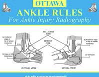 Ottawa Ankle Rules