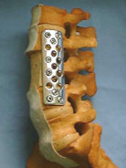 bonegraft