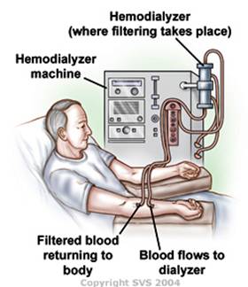 Hemodialysis