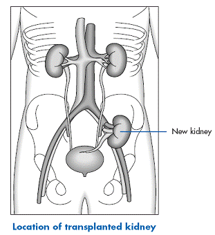 Transplantation