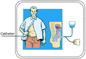 Peritoneal Dialysis