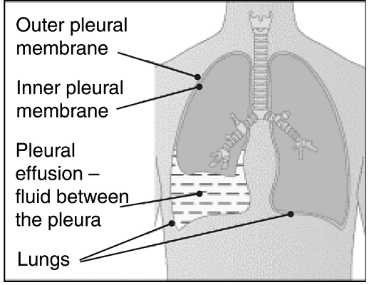 does copd show up on a lung x ray