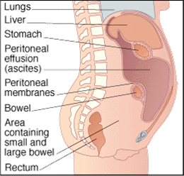 malignanteffusiondiagram2