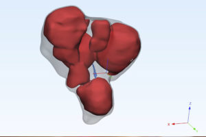 Tomour MRI