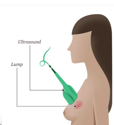 Image of a patient getting an ultrasoud to diagnose a breast lump