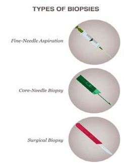 three types of biopsies: fine-needle aspiration, core-needle biospy and surgical bipsy