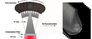 Breast Tomosynthesis