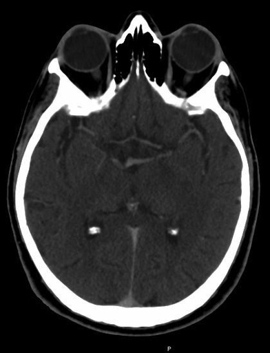 CT scan of a brain