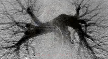X-Ray Image of Lung Angio