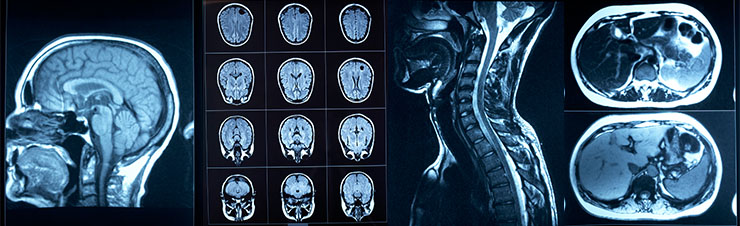  MRI scan of a human brain and body