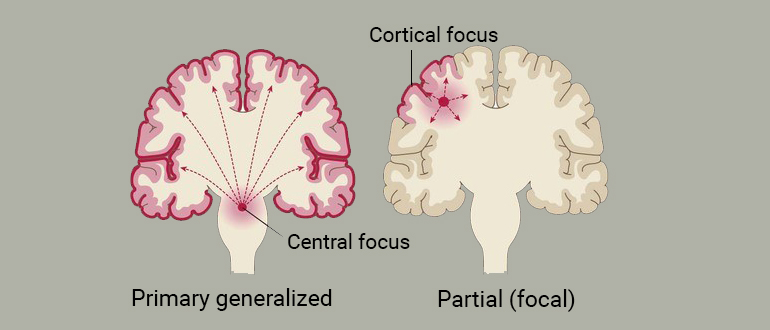 epilepsy diagram 