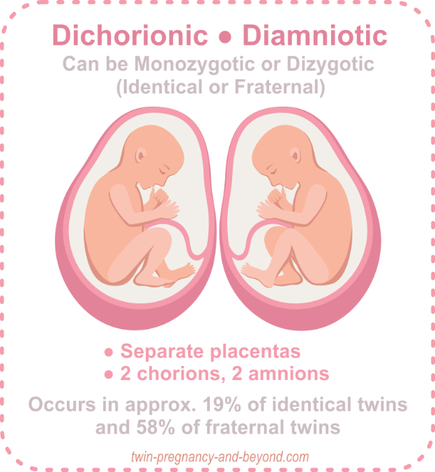 Dichorionic Diamniotic separate placentas