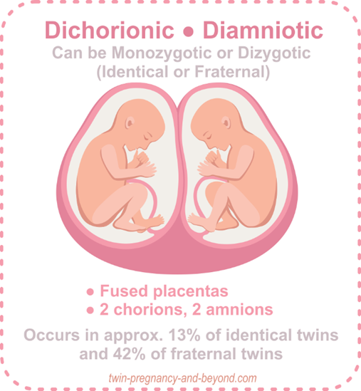 Dichorionic Diamniotic fused placentas