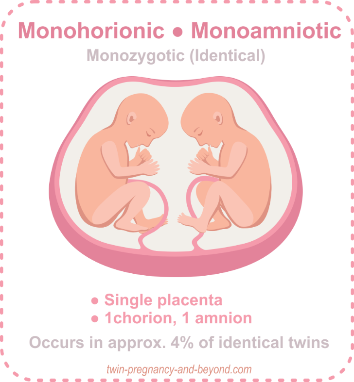 Monozygotes-Monoamniotiques