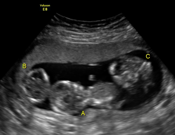 Triplets ultrasound