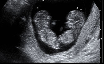 Ultrasound image of twins