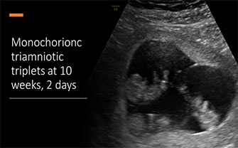 Monochorionic-triamniotic triplets at 10 weeks, 2 days