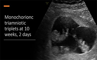 Triplés Monozygotes-triamniotiques à 10 semaines, 2 jours