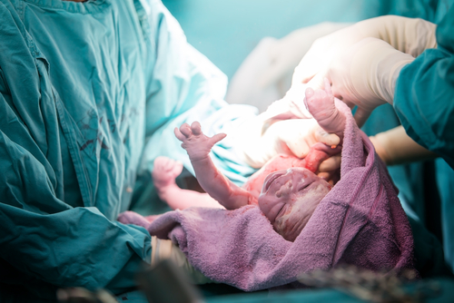 Surgical team performing surgery operation. Doctor performing surgery using sterilized equipment. Gynecologists and midwifes giving birth. Infant in maternity hospital