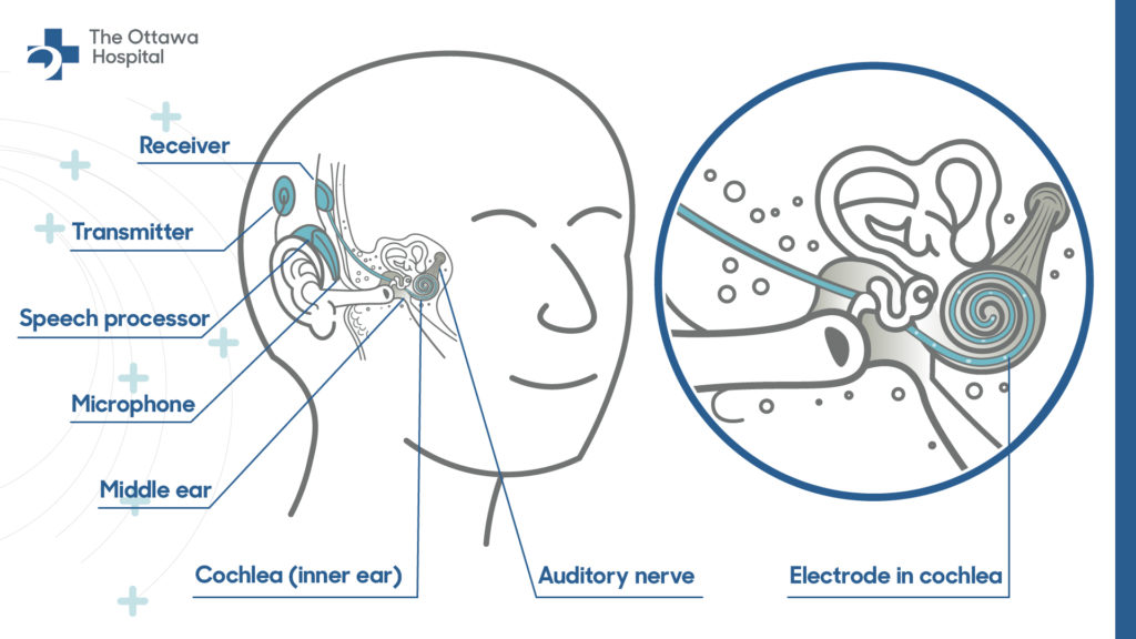 Graphic of inside a person’s ear showing the receiver, transmitter, speech processor, microphone, middle ear, cochlea (inner ear) and auditory nerve. Graphic showing a closeup view of where the electrode sits in relation to the cochlea