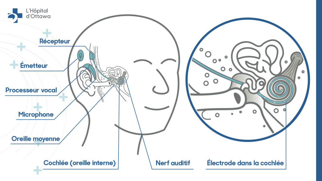Vue de l’intérieur d’une oreille qui montre le receveur, le transmetteur, le processeur de parole, le microphone, l’oreille moyenne, la cochlée (dans l’oreille interne) et le nerf auditif et vue agrandie qui montre l’électrode dans la cochlée.