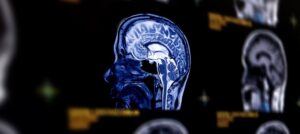CT Scan